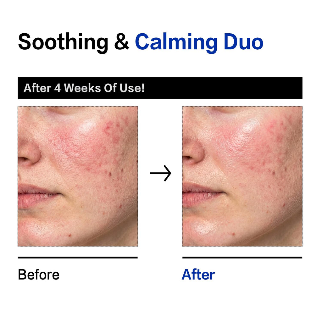 Comparatif avant/après de peau du visage, duo de sérum apaisant