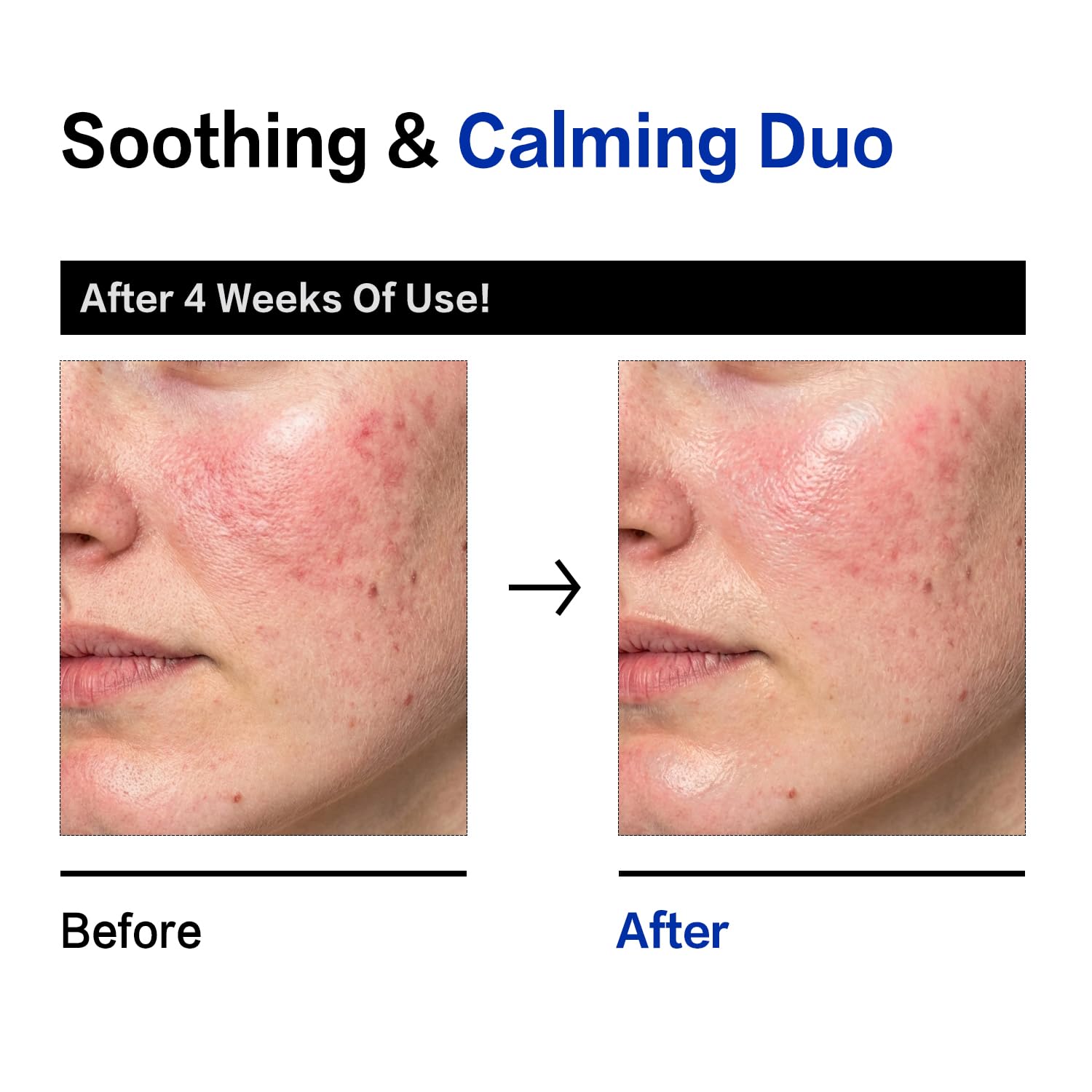 Comparatif avant/après de peau du visage, duo de sérum apaisant